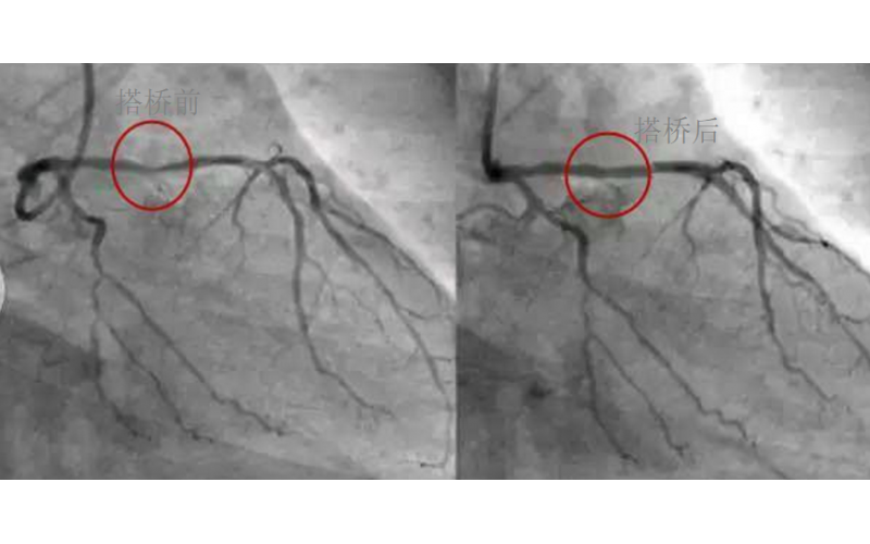 深圳市模具廠對心臟支架的關注，國產化的道路有多長？